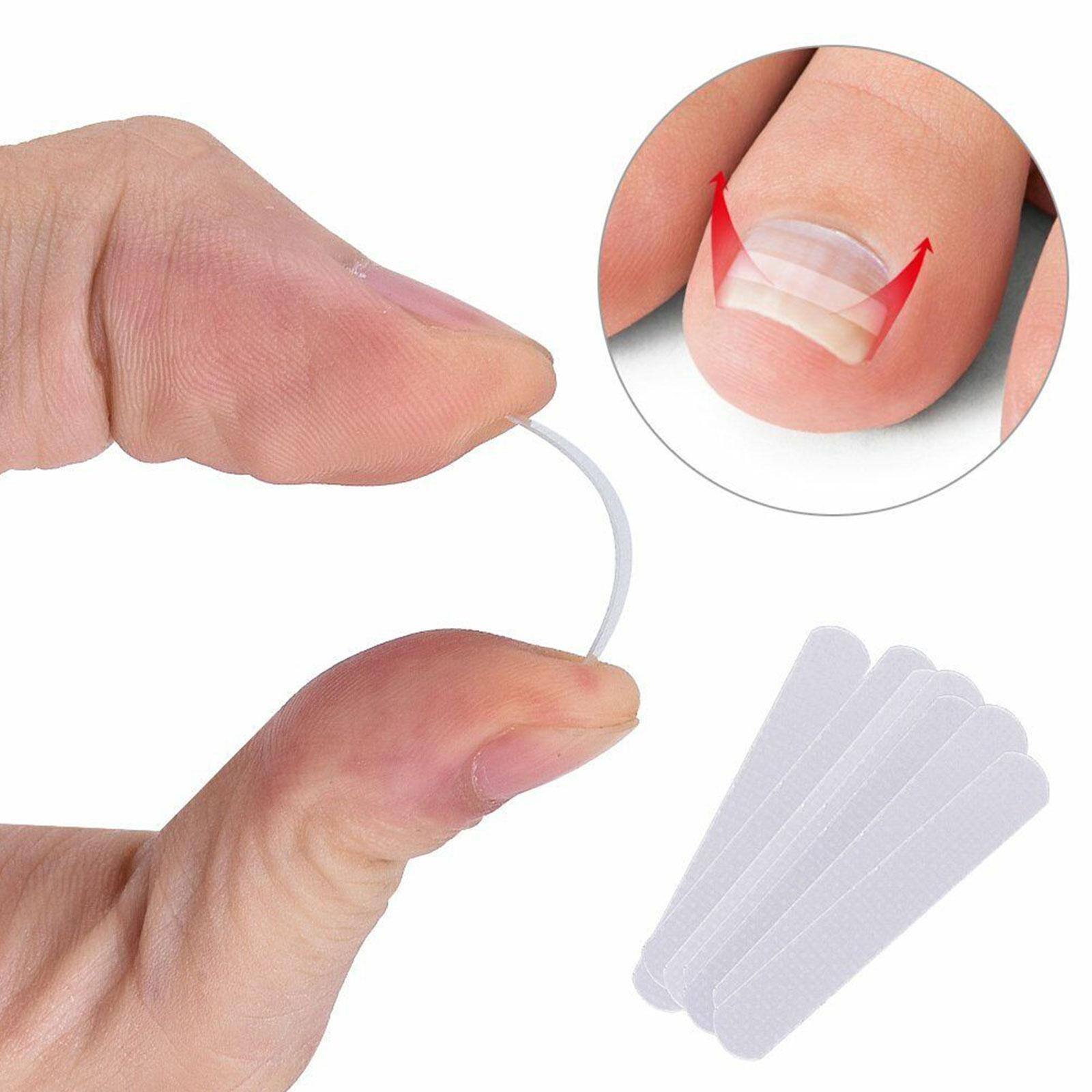 10pcs/set Ingrown Toenail Straightening Clip Elastic Patch Straightening Clip Curved Brace Toenails Correction Elastic Sticker